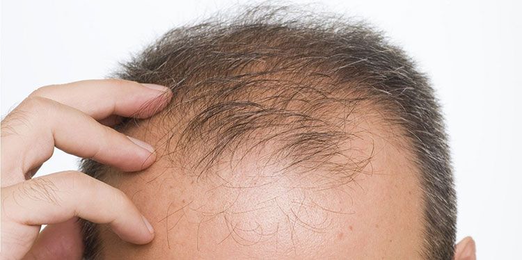 <Een PRP behandeling remt haarverlies en herstelt nieuwe haargroei, ook op plekken waar geen haar meer is.